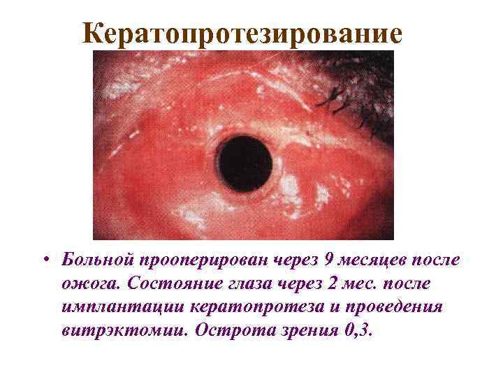 Кератопротезирование • Больной прооперирован через 9 месяцев после ожога. Состояние глаза через 2 мес.
