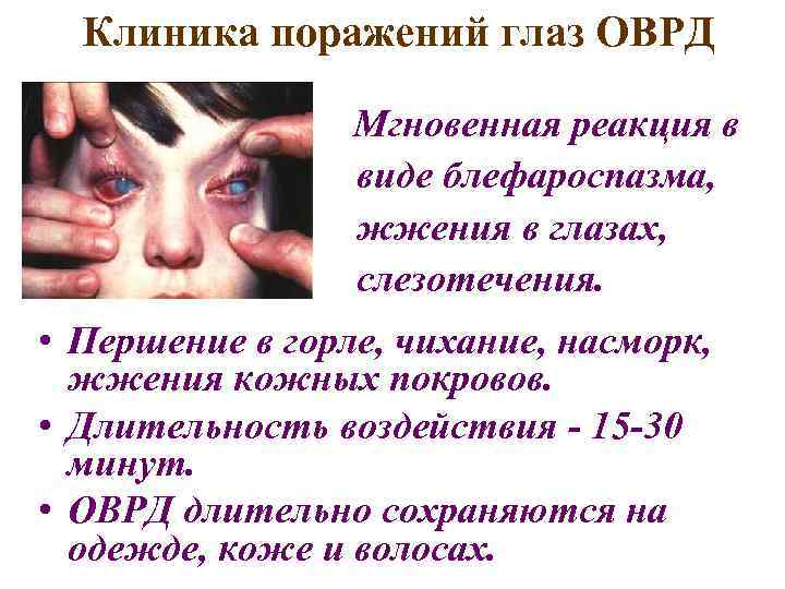 Клиника поражений глаз ОВРД Мгновенная реакция в виде блефароспазма, жжения в глазах, слезотечения. •