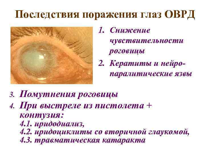 Последствия поражения глаз ОВРД 1. Снижение чувствительности роговицы 2. Кератиты и нейропаралитические язвы 3.