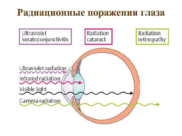 Радиационные поражения глаза 