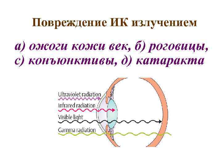 Повреждение ИК излучением а) ожоги кожи век, б) роговицы, с) конъюнктивы, д) катаракта 