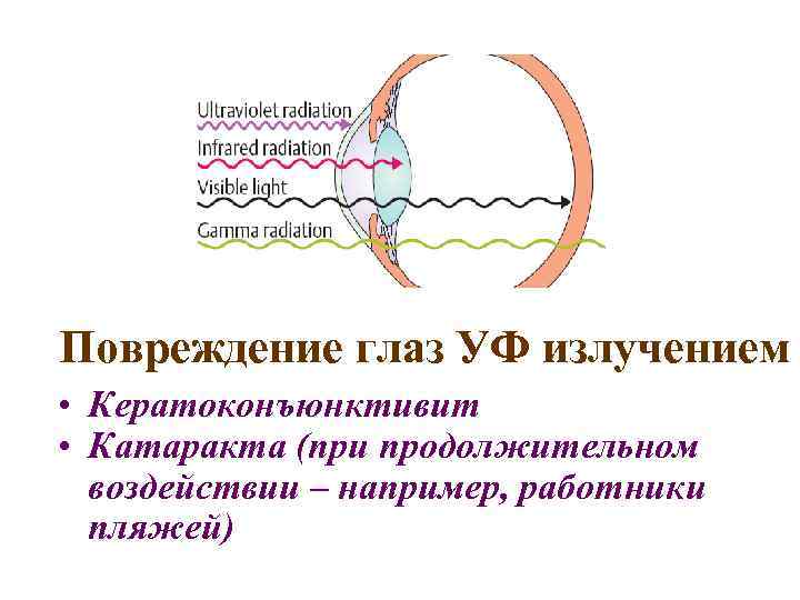 Повреждение глаз УФ излучением • Кератоконъюнктивит • Катаракта (при продолжительном воздействии – например, работники