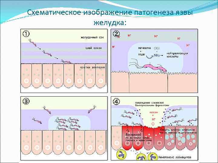 Схематическое изображение патогенеза язвы желудка: 