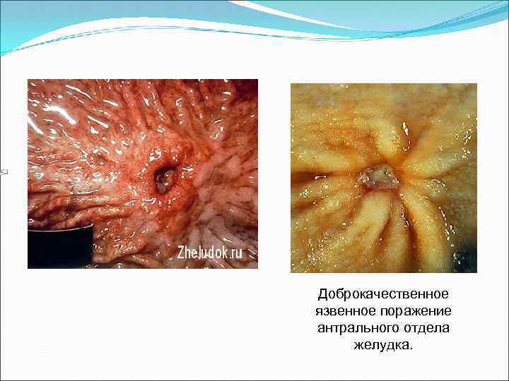 Доброкачественное язвенное поражение антрального отдела желудка. 