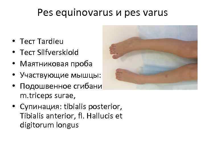 Pes equinovarus и pes varus Тест Tardieu Тест Silfverskiold Маятниковая проба Участвующие мышцы: Подошвенное