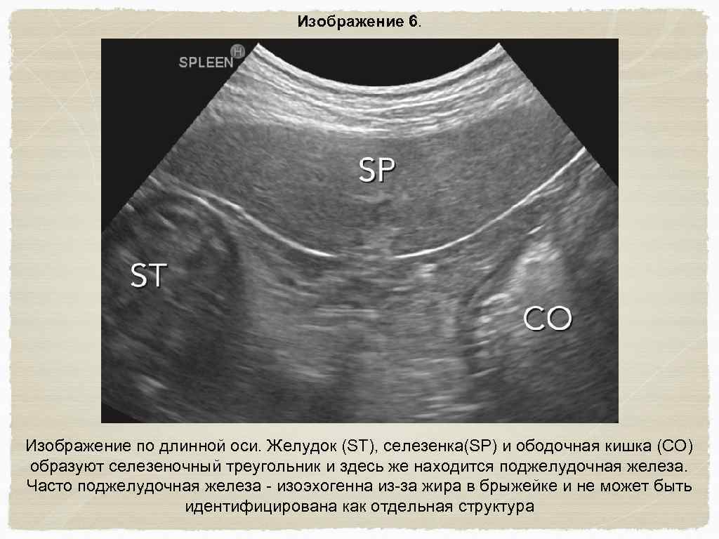 Изображение 6. Изображение по длинной оси. Желудок (ST), селезенка(SP) и ободочная кишка (CO) образуют
