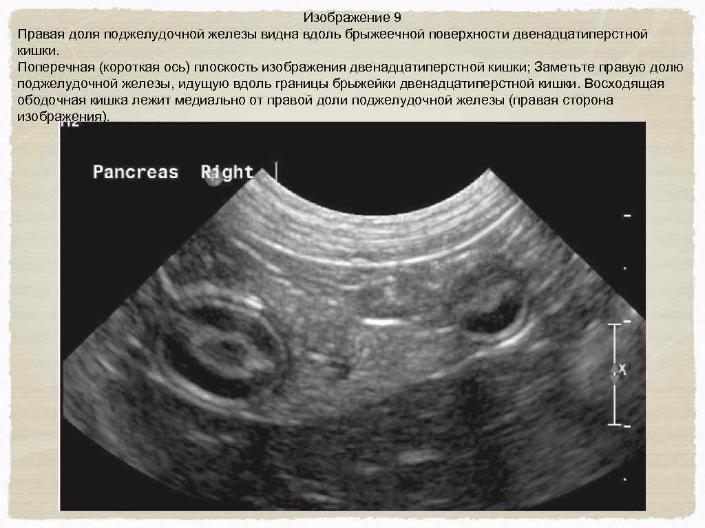 Что входит в узи брюшной. Поперечная плоскость УЗИ брюшной полости. Изображение поджелудочной железы в поперечной плоскости УЗИ. Новообразования брюшной полости брыжейки на УЗИ.
