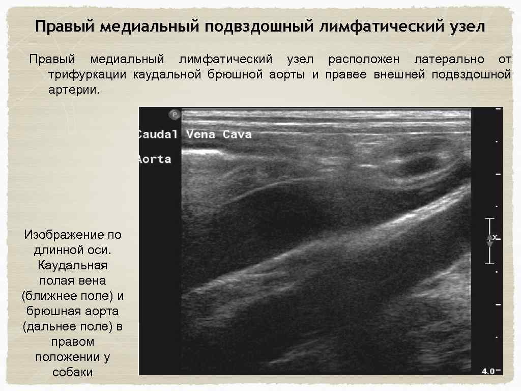 Подвздошные лимфоузлы увеличены. УЗИ подвздошных лимфоузлов. Подвздошные лимфоузлы на УЗИ.