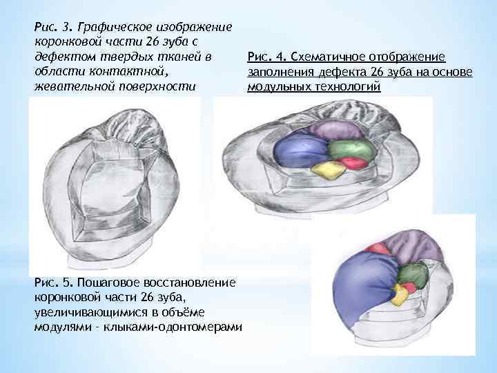 Рис. 3. Графическое изображение коронковой части 26 зуба с дефектом твердых тканей в области