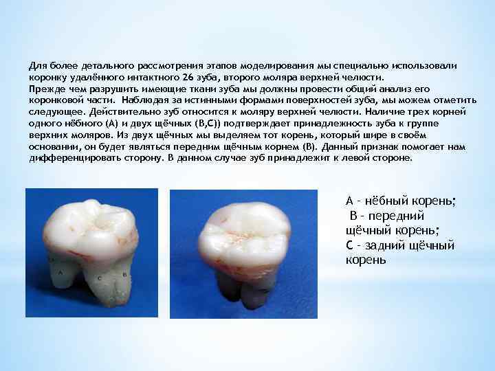Для более детального рассмотрения этапов моделирования мы специально использовали коронку удалённого интактного 26 зуба,