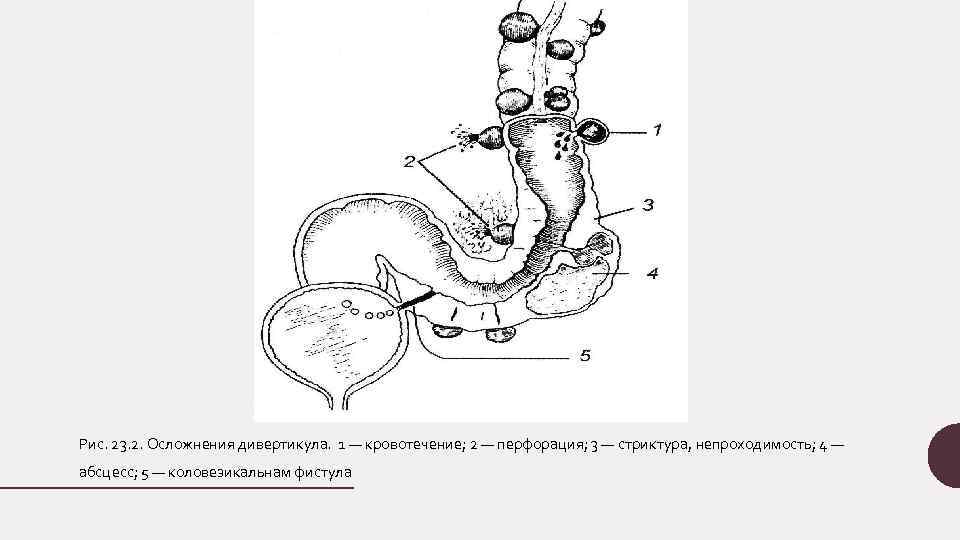 Рис. 23. 2. Осложнения дивертикула. 1 — кровотечение; 2 — перфорация; 3 — стриктура,