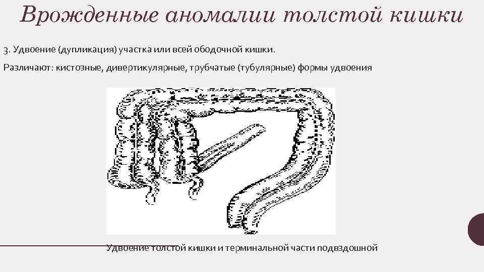 Врожденные аномалии толстой кишки 3. Удвоение (дупликация) участка или всеи ободочнои кишки. Различают: кистозные,