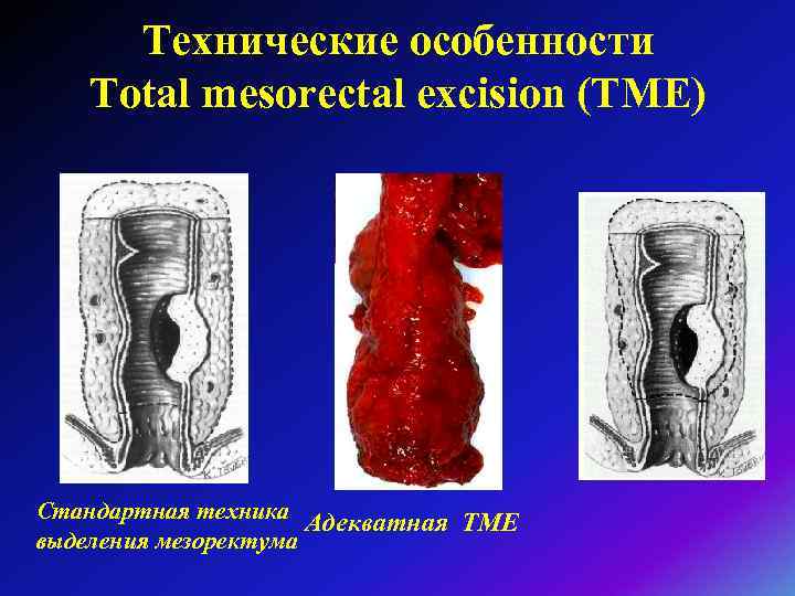 Технические особенности Total mesorectal excision (TME) Стандартная техника Адекватная ТМЕ выделения мезоректума 