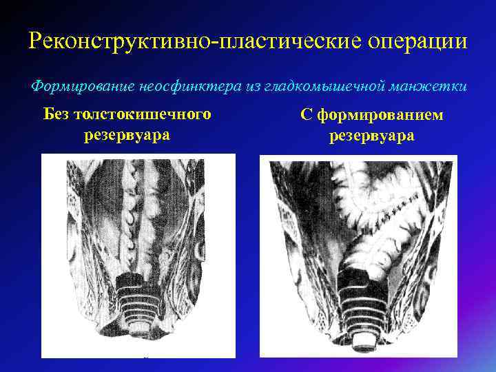 Реконструктивно-пластические операции Формирование неосфинктера из гладкомышечной манжетки Без толстокишечного резервуара С формированием резервуара 