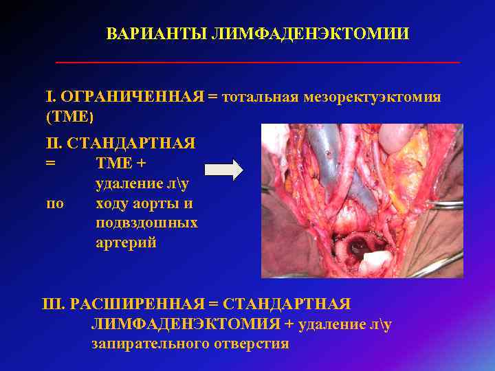 ВАРИАНТЫ ЛИМФАДЕНЭКТОМИИ ________________________ I. ОГРАНИЧЕННАЯ = тотальная мезоректуэктомия (ТМЕ) II. СТАНДАРТНАЯ = ТМЕ +