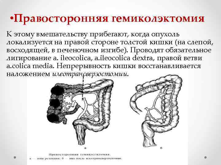  • Правосторонняя гемиколэктомия К этому вмешательству прибегают, когда опухоль локализуется на правой стороне