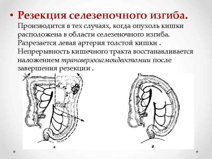  • Резекция селезеночного изгиба. Производится в тех случаях, когда опухоль кишки расположена в