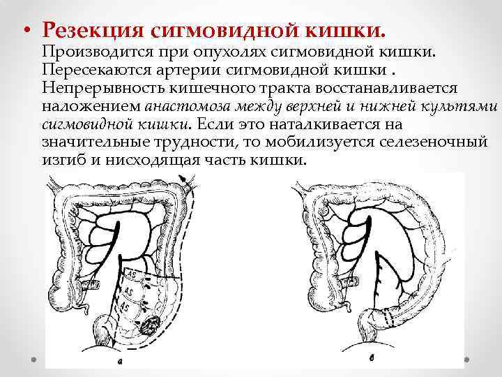  • Резекция сигмовидной кишки. Производится при опухолях сигмовидной кишки. Пересекаются артерии сигмовидной кишки.