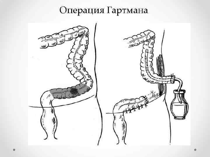 Операция Гартмана 