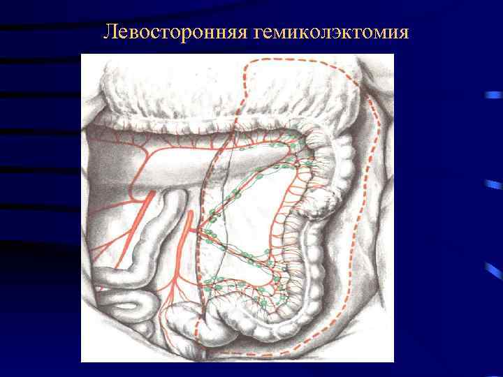 Левосторонняя гемиколэктомия 