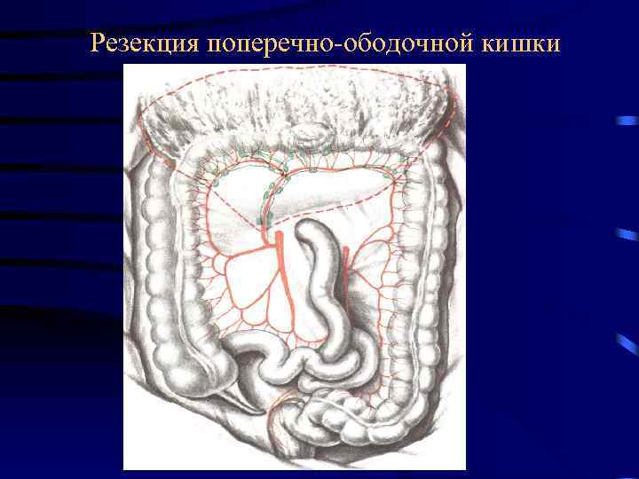 Резекция поперечно-ободочной кишки 