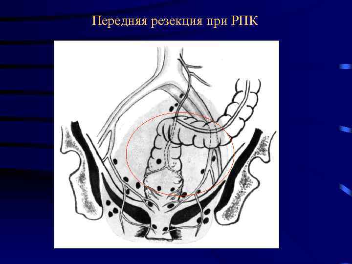 Передняя резекция при РПК 