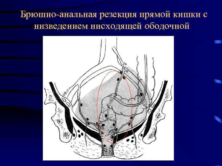 Колоректальный рак онкология презентация