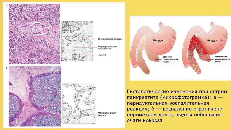  Гистологические изменения при остром панкреатите (микрофотограмма): а — перидуктальная воспалительная реакция; б —