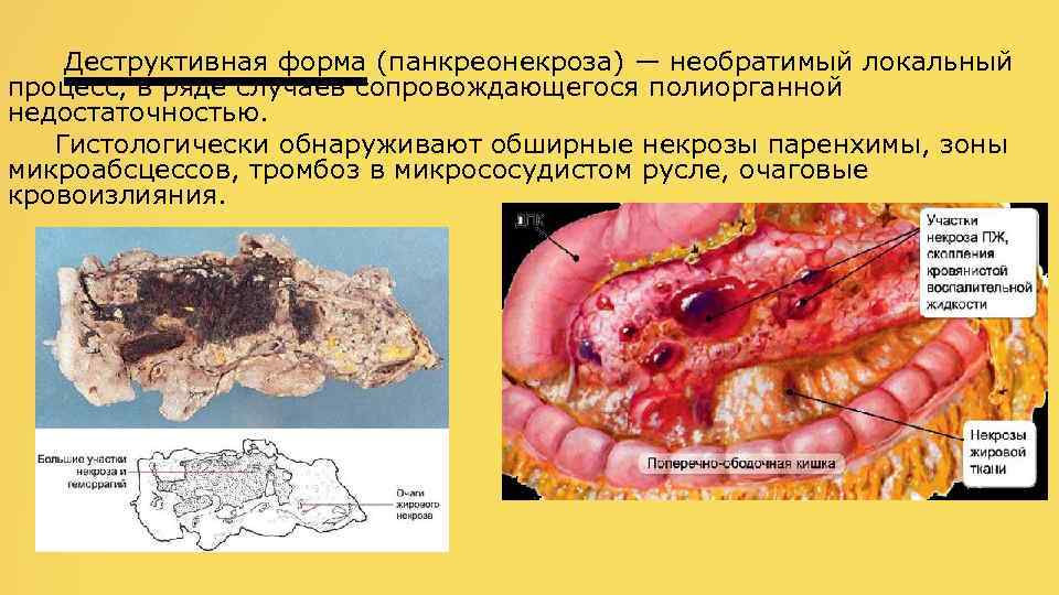  Деструктивная форма (панкреонекроза) — необратимый локальный процесс, в ряде случаев сопровождающегося полиорганной недостаточностью.