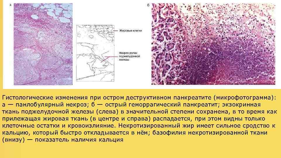 Гистологические изменения при остром деструктивном панкреатите (микрофотограмма): а — панлобулярный некроз; б — острый