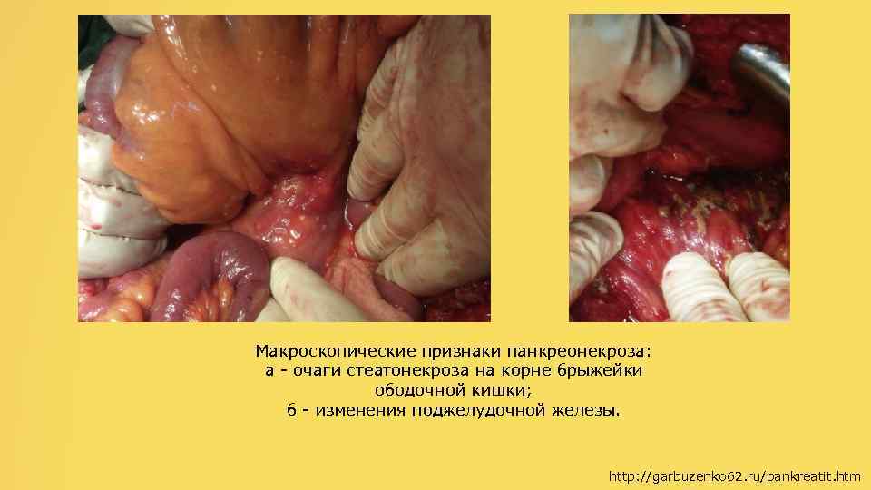 Макроскопические признаки панкреонекроза: а - очаги стеатонекроза на корне брыжейки ободочной кишки; б -