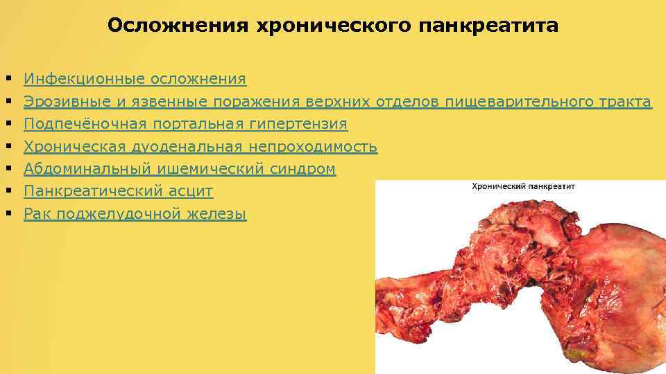 Осложнения хронического панкреатита § § § § Инфекционные осложнения Эрозивные и язвенные поражения верхних