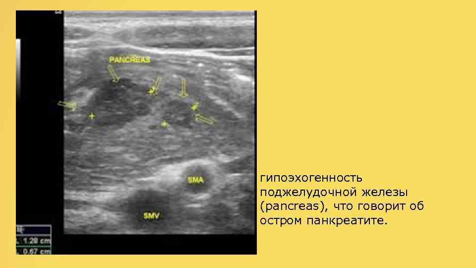 гипоэхогенность поджелудочной железы (pancreas), что говорит об остром панкреатите. 