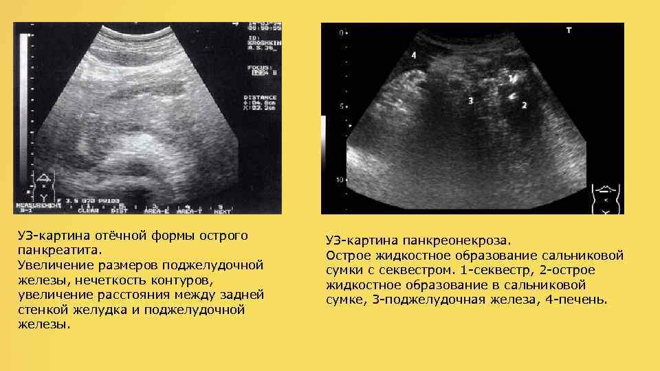 УЗ-картина отёчной формы острого панкреатита. Увеличение размеров поджелудочной железы, нечеткость контуров, увеличение расстояния между