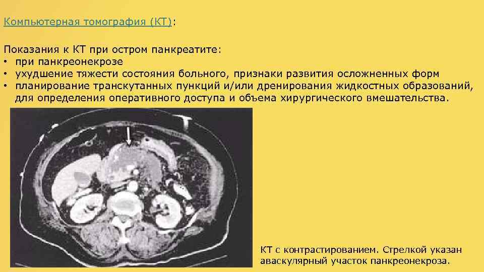 Кт картина панкреатита