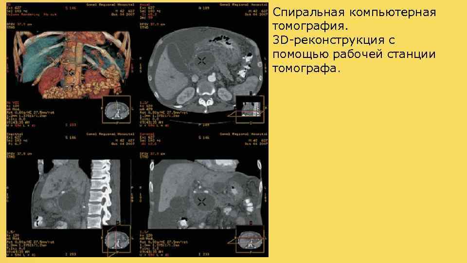 Спиральная компьютерная томография. 3 D-реконструкция с помощью рабочей станции томографа. 
