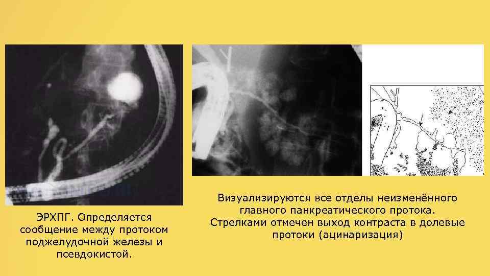 ЭРХПГ. Определяется сообщение между протоком поджелудочной железы и псевдокистой. Визуализируются все отделы неизменённого главного