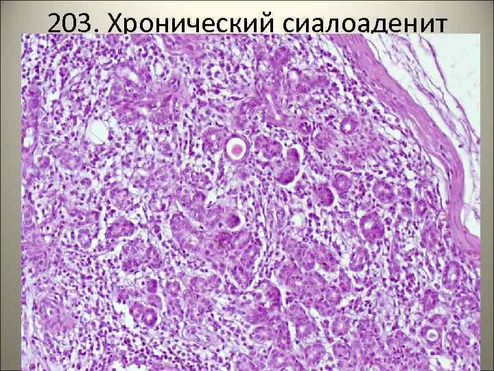 203. Хронический сиалоаденит 