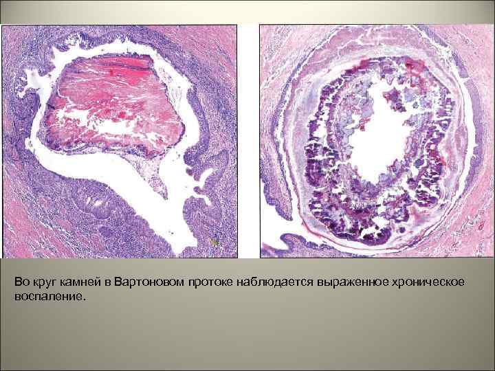 Опухоль слюнной железы фото