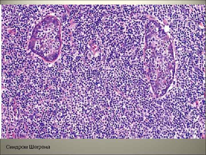 Синдром Шегрена 