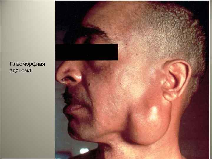 Плеоморфная аденома 