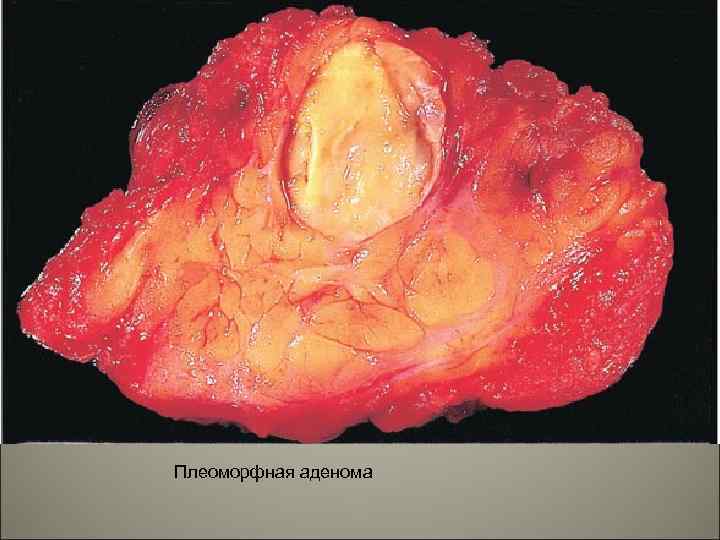 Плеоморфная аденома 