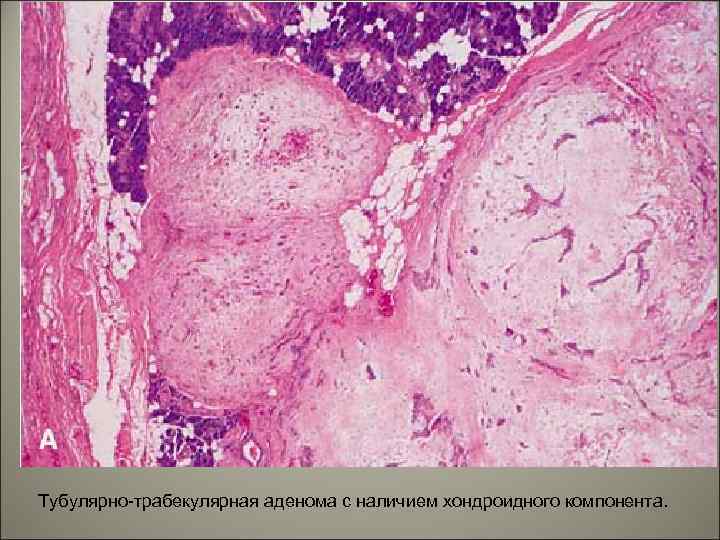 Тубулярно-трабекулярная аденома с наличием хондроидного компонента. 