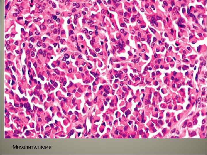 Миоэпителиома 