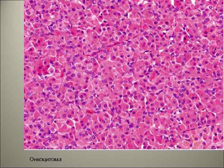 Онкоцитома 