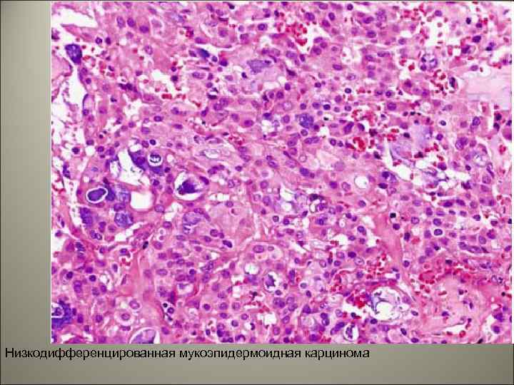Низкодифференцированная мукоэпидермоидная карцинома 