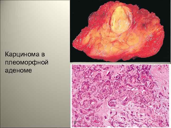 Карцинома в плеоморфной аденоме 