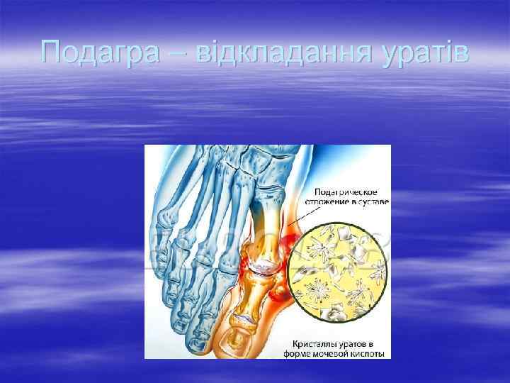 Подагра – відкладання уратів 