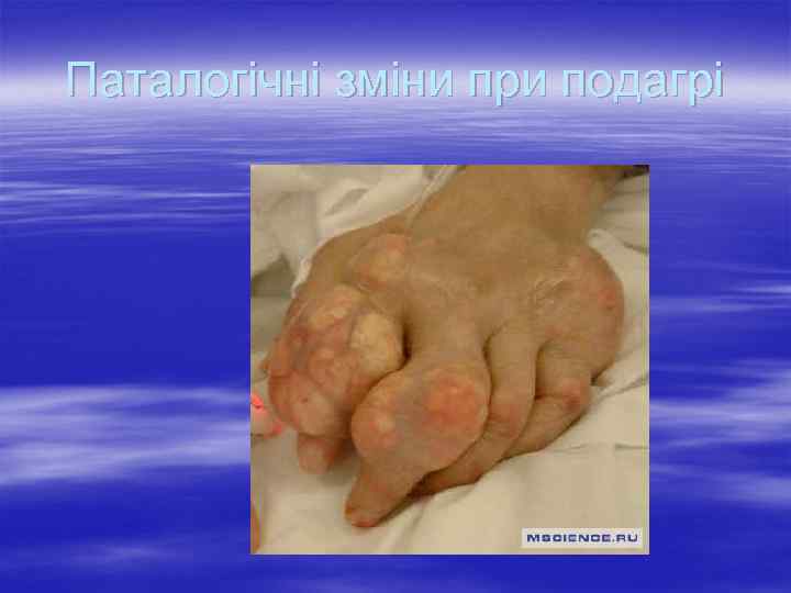 Паталогічні зміни при подагрі 
