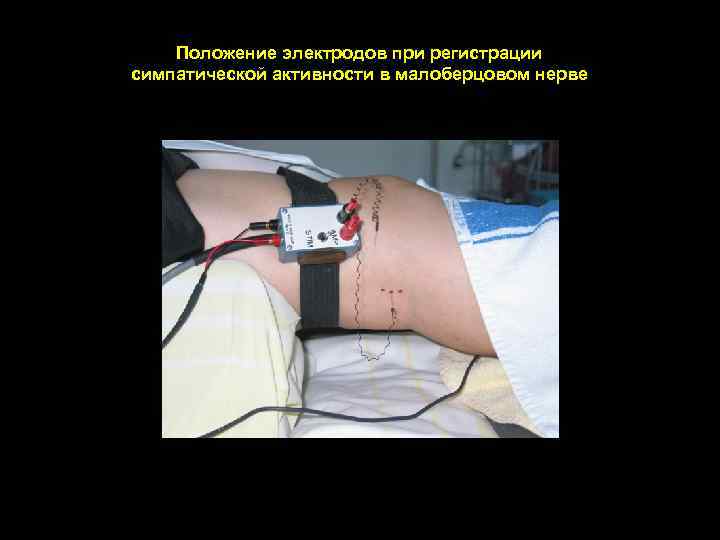 Положение электродов при регистрации симпатической активности в малоберцовом нерве 